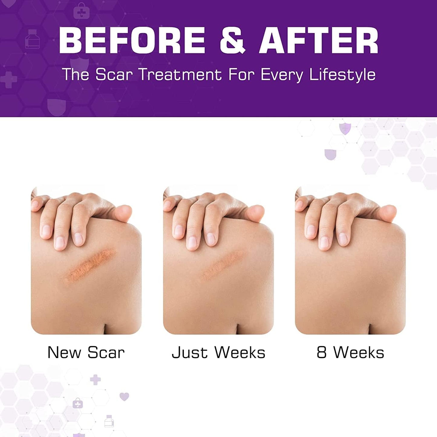 Silicone Scar Sheets – 1.6" x 60" Medical Grade Roll – Soft Gel Tape for C-Section & Surgery Scars – Reusable & Pain-Free Removal