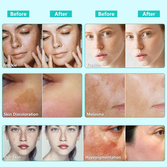 Dark Spot Remover for Face and Body – Fades Dark Spots, Acne Scars, Sun Damage & Uneven Tone – Fast Results with Advanced Ingredients (1.7 oz)